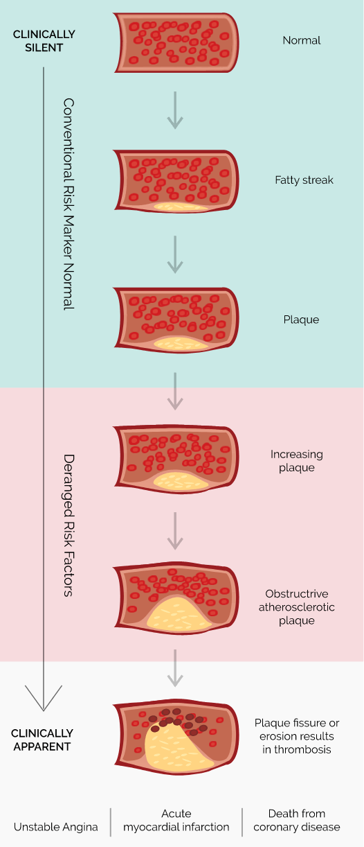 Graphic showing how coronary disease affects.